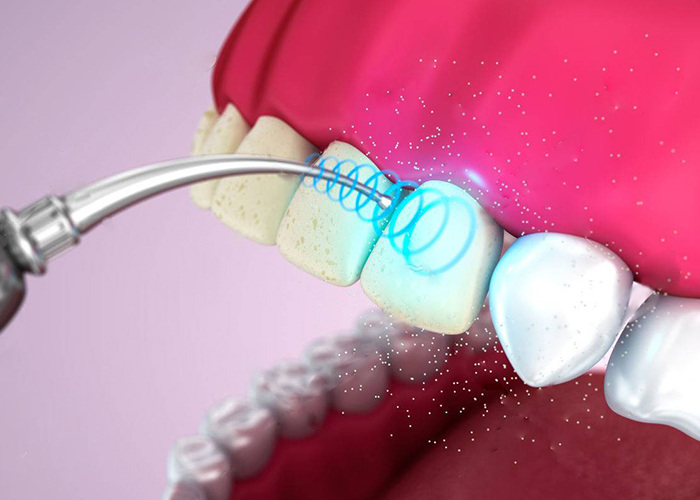 Ультразвуковая чистка зубов Air Flow
